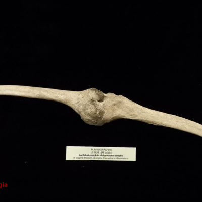 Anchilosi ginocchio