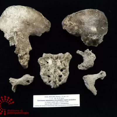 Carcinoma metastatico