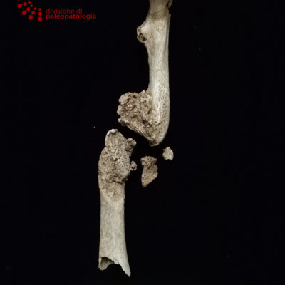 Pseudoartrosi